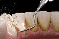 همه چیز درباره جرم‌گیری دندان