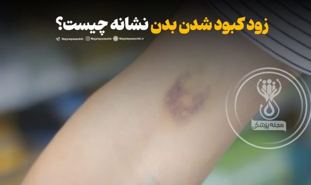 زود کبود شدن بدن نشانه چیست؟