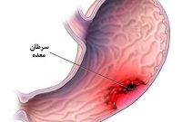 علائم سرطان معده را بشناسیم