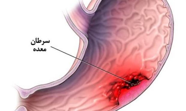 علائم سرطان معده را بشناسیم